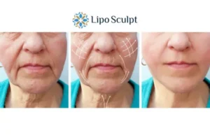 Explaining Morpheus8 And What It Can Do For You 3 Boost your confidence with Morpheus8 Nuneaton call our team today!